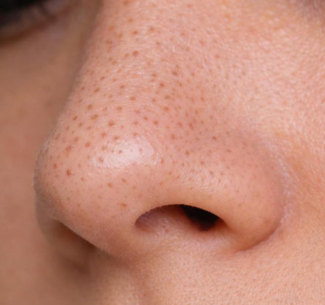 Pormaskar & Förstorade porer